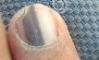 Melanoma in a toenail